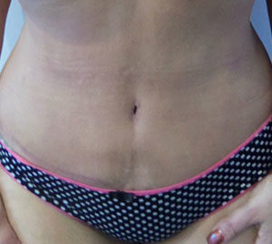 Tummy Tuck Before and After Pictures Washington, DC