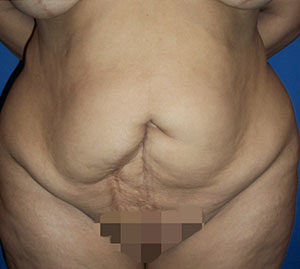 Tummy Tuck Before and After Pictures Washington, DC