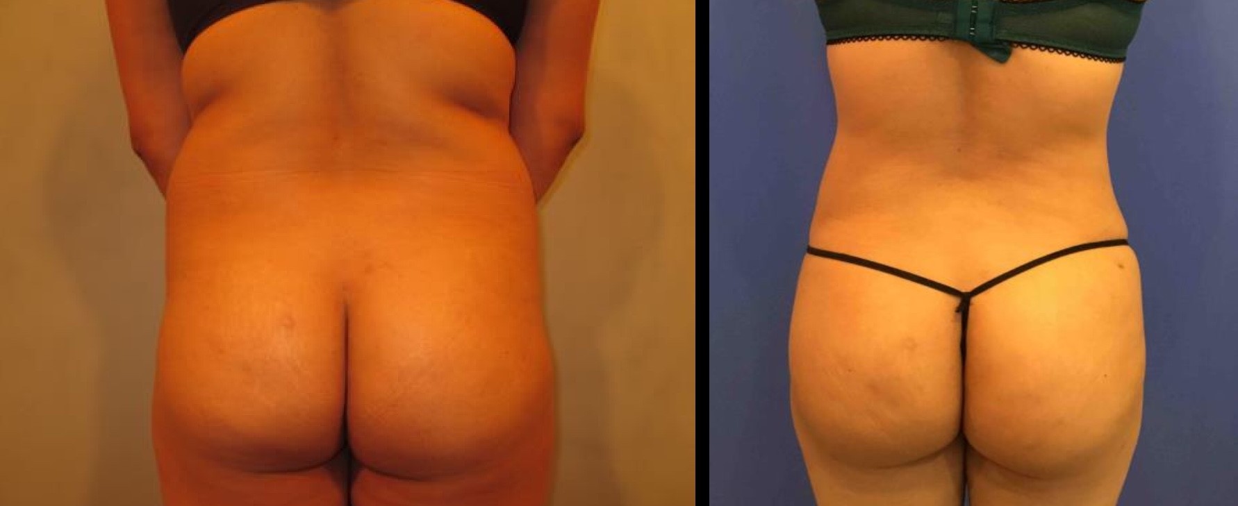 Fat Transfer to Buttocks Before and After Pictures Washington, DC