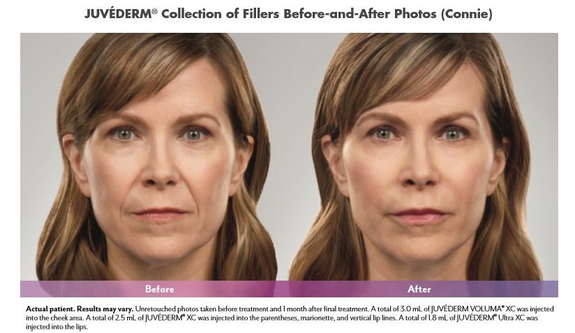 Juvederm® in Washington, DC