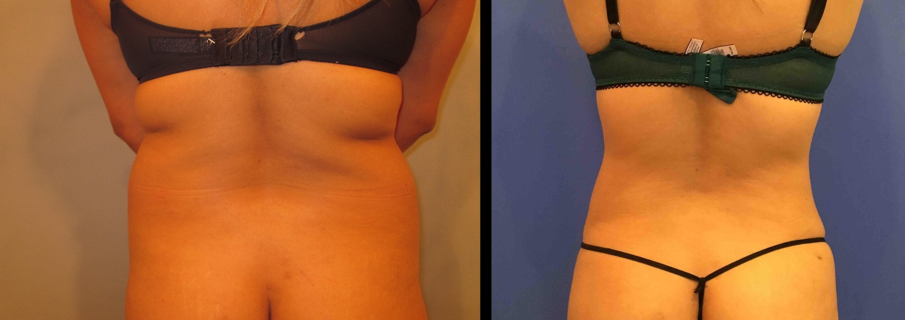 Liposuction Before and After Pictures Washington, DC