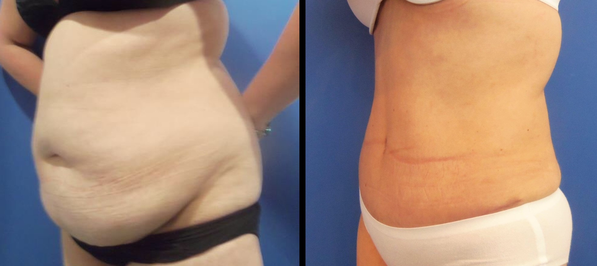 Tummy Tuck Before and After Pictures Washington, DC