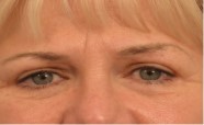 Eyelid Surgery Before and After Pictures Washington, DC