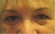 Eyelid Surgery Before and After Pictures Washington, DC