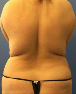 Laser Liposuction Before and After Pictures Washington, DC