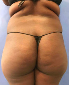 Laser Liposuction Before and After Pictures Washington, DC