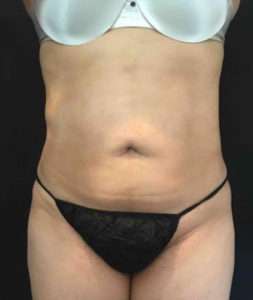 Laser Liposuction Before and After Pictures Washington, DC