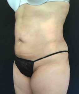 Laser Liposuction Before and After Pictures Washington, DC