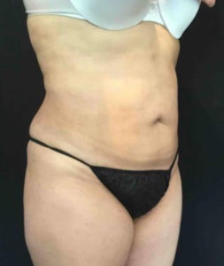 Laser Liposuction Before and After Pictures Washington, DC