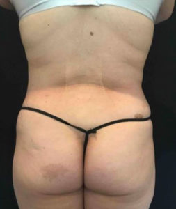 Laser Liposuction Before and After Pictures Washington, DC