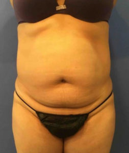 Laser Liposuction Before and After Pictures Washington, DC