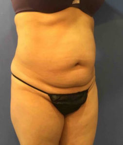 Laser Liposuction Before and After Pictures Washington, DC