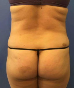 Laser Liposuction Before and After Pictures Washington, DC