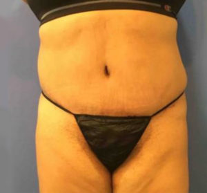 Tummy Tuck Before and After Pictures Washington, DC