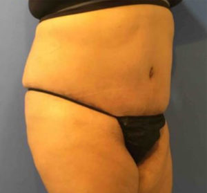 Tummy Tuck Before and After Pictures Washington, DC