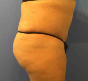 Tummy Tuck Before and After Pictures Washington, DC