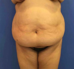 Tummy Tuck Before and After Pictures Washington, DC