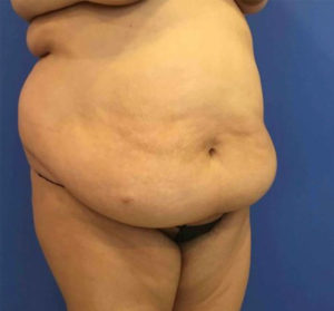 Tummy Tuck Before and After Pictures Washington, DC