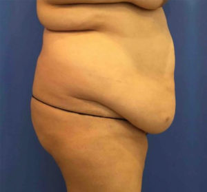 Tummy Tuck Before and After Pictures Washington, DC