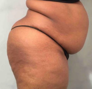 Tummy Tuck Before and After Pictures Washington, DC