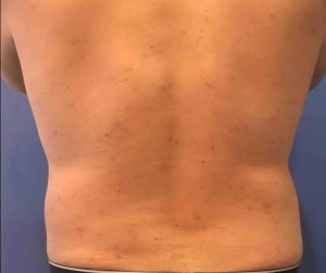 Laser Liposuction Before and After Pictures Washington, DC