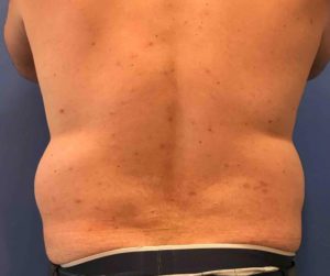 Laser Liposuction Before and After Pictures Washington, DC