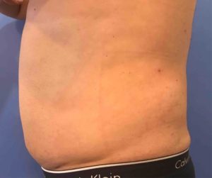 Laser Liposuction Before and After Pictures Washington, DC