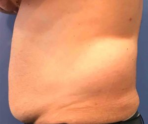 Laser Liposuction Before and After Pictures Washington, DC