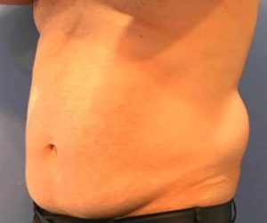 Laser Liposuction Before and After Pictures Washington, DC