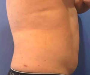 Laser Liposuction Before and After Pictures Washington, DC