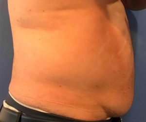 Laser Liposuction Before and After Pictures Washington, DC