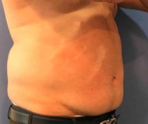 Laser Liposuction Before and After Pictures Washington, DC