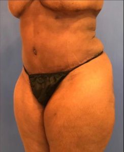 Tummy Tuck after photo