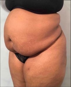 Tummy Tuck Before photo