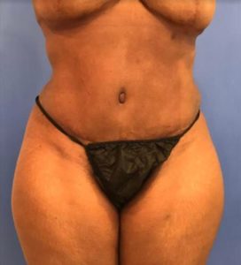 Tummy Tuck After Photo