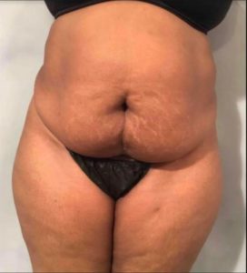 Tummy Tuck Before Photo