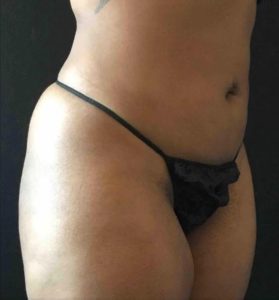 Lipo After Photo