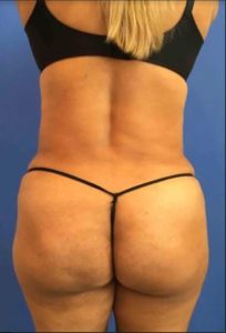 Liposuction after photo