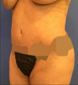 Tummy Tuck Before and After Pictures in Washington, Vienna, VA