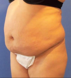 Tummy Tuck Before and After Pictures Washington, DC