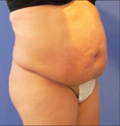 Tummy Tuck Before and After Pictures Washington, DC