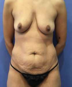 Breast Lift Before and After Pictures Washington, DC