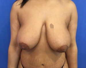 Breast Lift Before and After Pictures Washington, DC