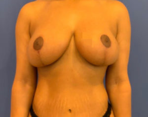 Breast Lift Before and After Pictures Washington, DC