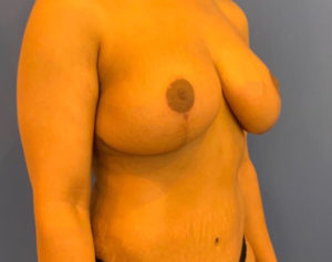Breast Lift Before and After Pictures Washington, DC