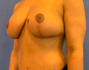 Breast Lift Before and After Pictures Washington, DC