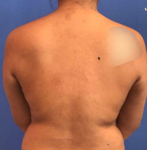 Liposuction Before and After Pictures Washington, DC