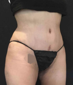 Tummy Tuck Before and After Pictures Washington, DC