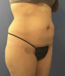 Tummy Tuck Before and After Pictures Washington, DC