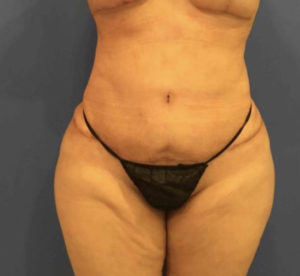 Tummy Tuck Before and After Pictures Washington, DC